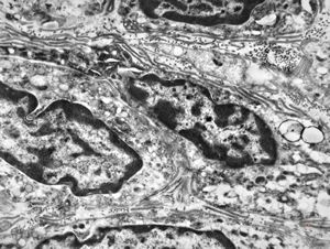 F,41y. | synovial metaplasia - capsule of implantate F,41y. | synovial metaplasia - capsule of implantate